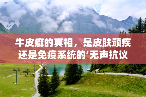 牛皮癣的真相，是皮肤顽疾还是免疫系统的‘无声抗议’？